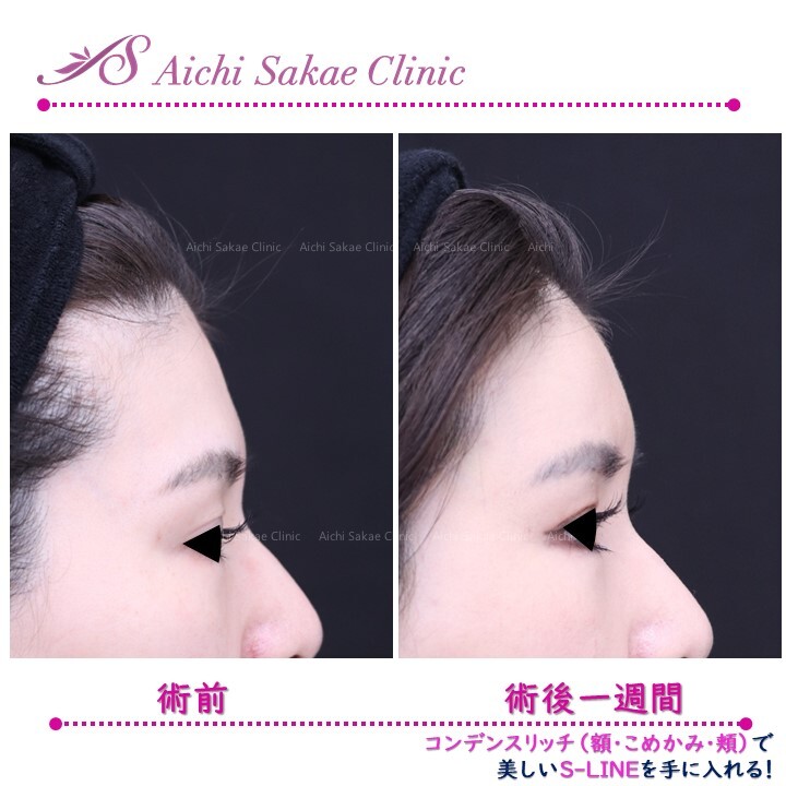 脂肪注入で理想通りの輪郭美人に 輪郭 顎 エラ 額 小顔整形の症例写真 画像 あいち栄クリニック Cs 美容医療の口コミ広場