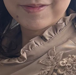 ペルラクリニック神宮前のリフトアップの症例写真[ビフォー]