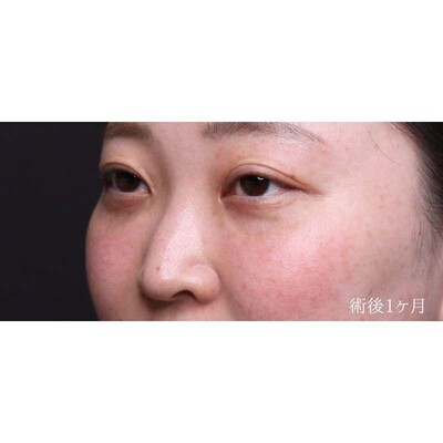 裏ハムラ法でふくらみと凹みの影を解消（術後1ヶ月）の症例写真[アフター]