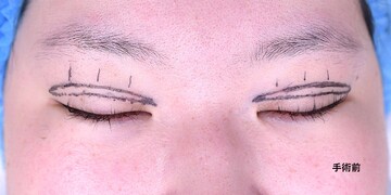 医療法人秀晄会 心斎橋コムロ美容外科クリニックの目・二重整形の症例写真[ビフォー]