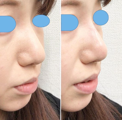 鼻が長く見えるのを改善したい ヒアルロン酸 クレビエル ヒアルロン酸注入 鼻 の症例写真 画像 しのぶ皮膚科 Cs 美容医療の口コミ広場
