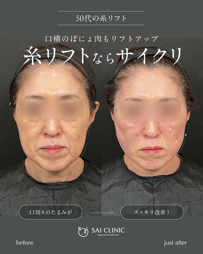 SAI LIFT STANDARDの症例写真