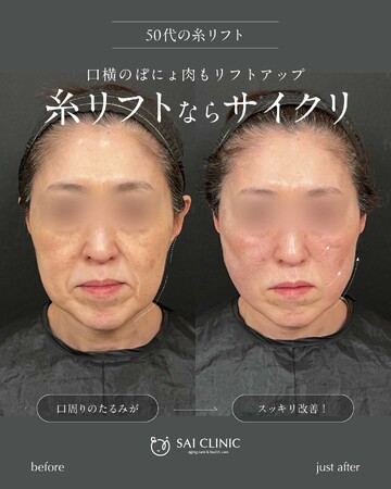 SAI CLINIC （サイクリニック）のリフトアップの症例写真