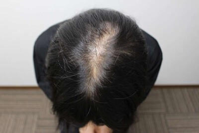 Rebirth+ミノキジェット｜20代｜4か月の症例写真[ビフォー]