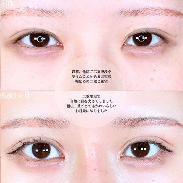 アリエル美容クリニック 大宮院の二重の症例写真