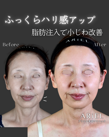アリエル美容クリニック 郡山院のしわ・たるみ整形(注入、糸、フェイスリフト)の症例写真