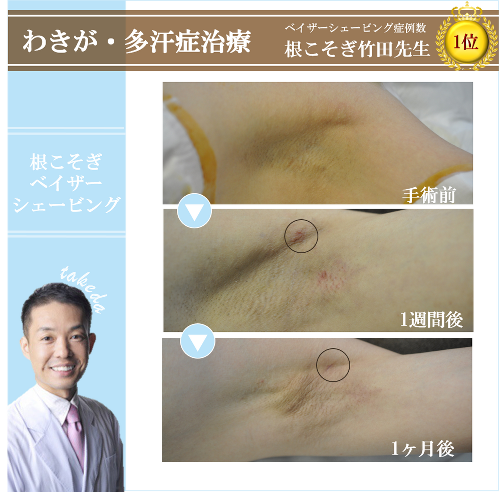 [30代 女性] ≪わきが・多汗症治療≫根こそぎベイザーシェービング（わきが手術・多汗症治療）の症例写真 (CS44210)｜湘南美容