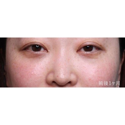 裏ハムラ法でふくらみと凹みの影を解消（術後1ヶ月）の症例写真[アフター]