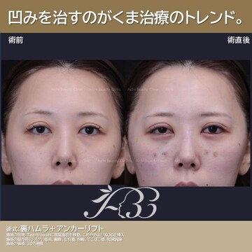 あいちビューティークリニック栄本院の目元・クマ・眉下・涙袋整形の症例写真