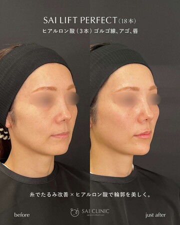 SAI CLINIC （サイクリニック）のリフトアップの症例写真