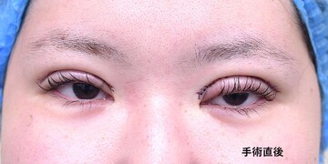 医療法人秀晄会 心斎橋コムロ美容外科クリニックの目・二重整形の症例写真[ビフォー]