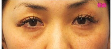 湘南美容クリニック 熊本院の目・二重整形の症例写真[ビフォー]