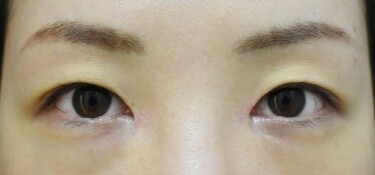 他院目頭切開術後修正の症例写真