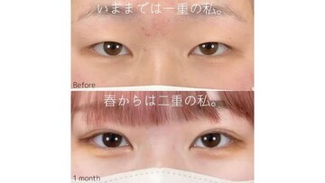 SAI CLINIC （サイクリニック）の二重の症例写真