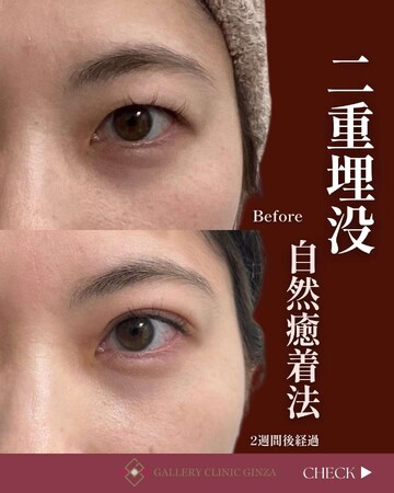 ギャラリークリニックの目・二重整形の症例写真