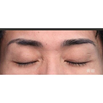 聖心美容クリニックの二重の症例写真[ビフォー]