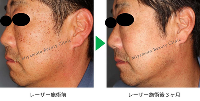 いぼレーザーの症例写真