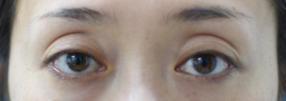 上まぶたのくぼみ取り 眠むたそうな目の改善 目元のくぼみの症例写真 画像 みずほクリニック Cs 美容医療の口コミ広場