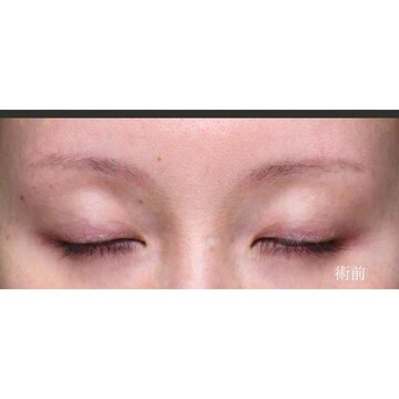 聖心美容クリニックの二重の症例写真[ビフォー]