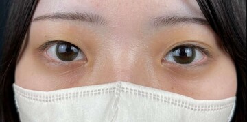 AI Beauty Clinicの二重の症例写真[ビフォー]