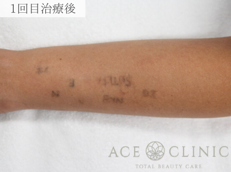 ピコレーザーによるタトゥー除去 腕 レーザー除去の症例 エースクリニックグループ Cs494 美容医療の口コミ広場