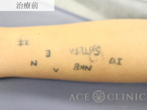 ピコレーザーによるタトゥー除去 腕 レーザー除去の症例 エースクリニックグループ Cs494 美容医療の口コミ広場