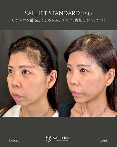 糸リフト（SAI LIFT STANDARD）＋ヒアルロン酸の症例写真