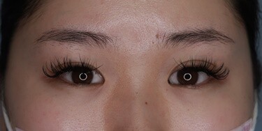 小さな傷しか作らない目頭切開ミニz法 目 二重整形の症例写真 画像 ポセンシアクリニック Cs 美容医療の口コミ広場