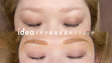 イデア美容皮膚科クリニックのアートメイクの症例写真