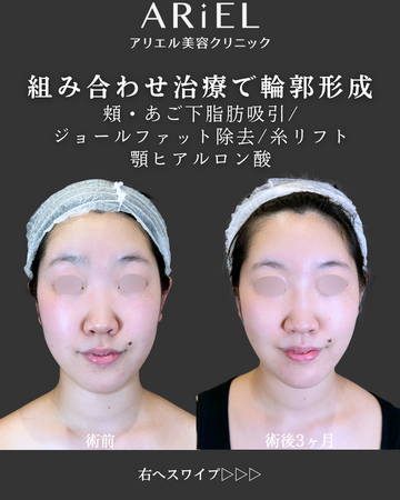 アリエル美容クリニック 郡山院の輪郭・顎・エラ・額・小顔整形の症例写真