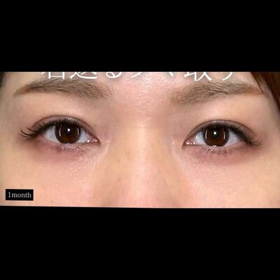 若返るクマ取り💡の症例写真[アフター]