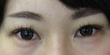 二重切開後の修正手術 術後1ヶ月 二重切開法 その他 二重整形 の症例写真 画像 カリスクリニック Cs 美容医療の口コミ広場