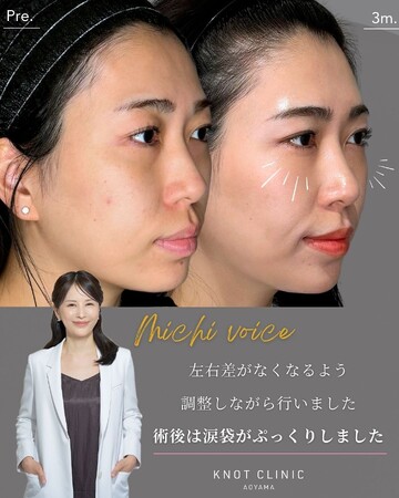 KNOT CLINIC AOYAMAの目元・クマ・眉下・涙袋整形の症例写真