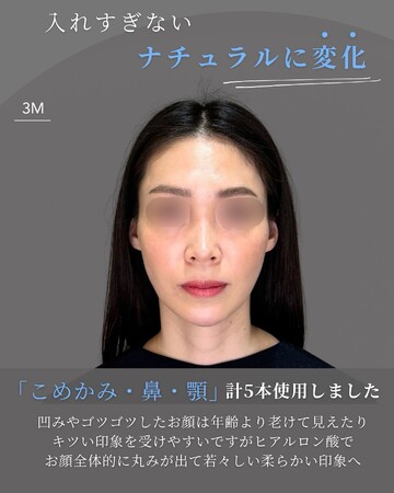 KNOT CLINIC AOYAMAの輪郭・顎・エラ・額・小顔整形の症例写真