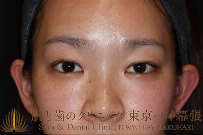二重埋没法 鼻のヒアルロン酸 20代女性 二重埋没法の症例写真 画像 肌と歯のクリニック 東京ベイ幕張 Cs 美容医療の口コミ 広場
