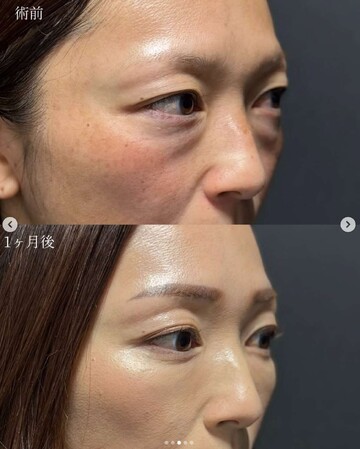 CLINIC Wの目元・クマ・眉下・涙袋整形の症例写真