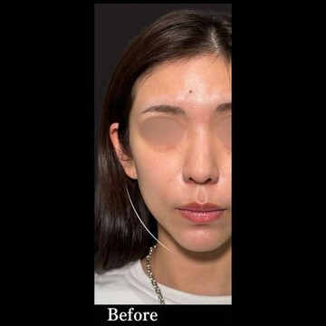 PRISM Beauty Clinicのリフトアップの症例写真[ビフォー]