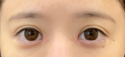 他院目頭切開術後の症例写真[アフター]