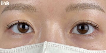 AI Beauty Clinicの二重の症例写真[ビフォー]