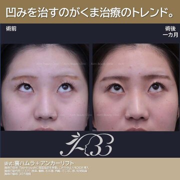 あいちビューティークリニック栄本院の目元・クマ・眉下・涙袋整形の症例写真