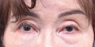 医療法人秀晄会 心斎橋コムロ美容外科クリニックの目・二重整形の症例写真[ビフォー]