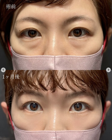 CLINIC Wの目元・クマ・眉下・涙袋整形の症例写真