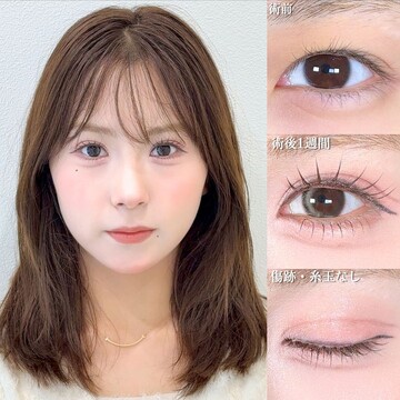 アリエル美容クリニック 大宮院の二重の症例写真