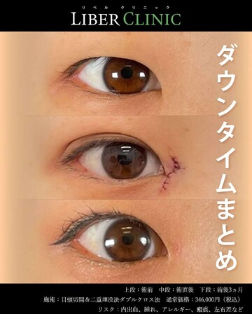 LIBER CLINIC （リベルクリニック）の目・二重整形の症例写真