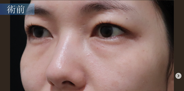 目の下のクマ取りクリニック 大阪梅田の目元・クマ・眉下・涙袋整形の症例写真[ビフォー]