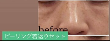 やさしい美容皮膚科・皮フ科 秋葉原院/シミレーザー東京のシミ・肝斑の症例写真[ビフォー]