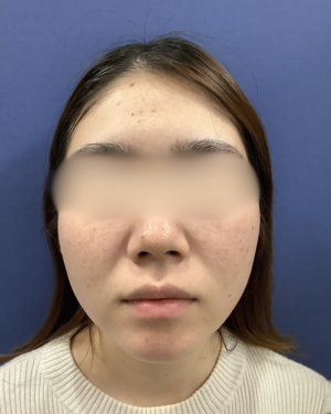 ニキビ治療(ケミカルピーリング、光線治療など)の症例写真[アフター]