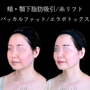 アリエル美容クリニック 大宮院の脂肪吸引の症例写真