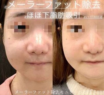 ルラ（LULA）美容クリニックの輪郭・顎・エラ・額・小顔整形の症例写真