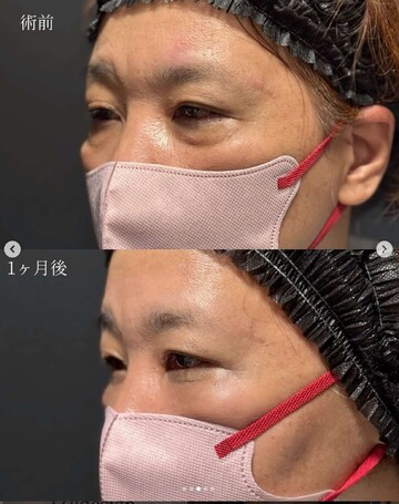 CLINIC Wの目元・クマ・眉下・涙袋整形の症例写真